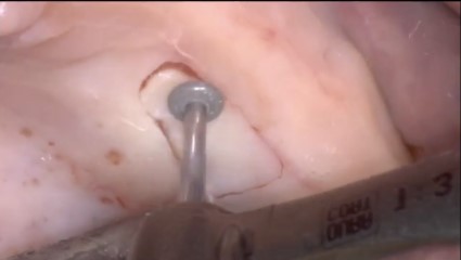 Soft tissue management at immediate implant placement